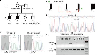 Case report: Novel compound heterozygous IL1RN mutations as the likely cause of a lethal form of deficiency of interleukin-1 receptor antagonist